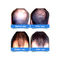 Laser-Haar-Wachstums-Kappen der Klassen-II der Dioden-5mW für Haarausfall